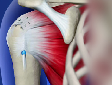 best rotator cuff surgery doctor in indore