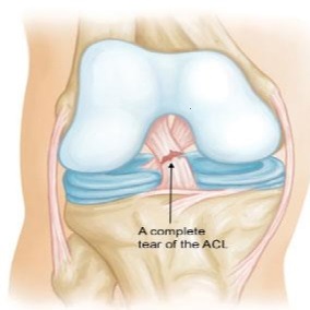 ACL surgery in indore