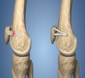 medial patellofemoral ligament reconstruction in indore