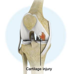 cartilage regeneration in indore