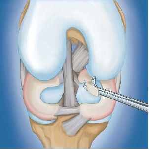 meniscus repair surgery in indore