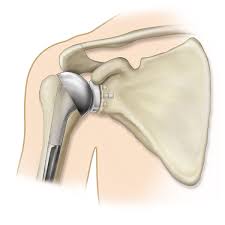 total shoulder replacement surgery in indore